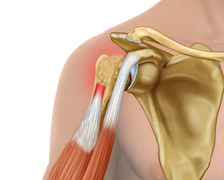 Long head of biceps (LHB) rupture